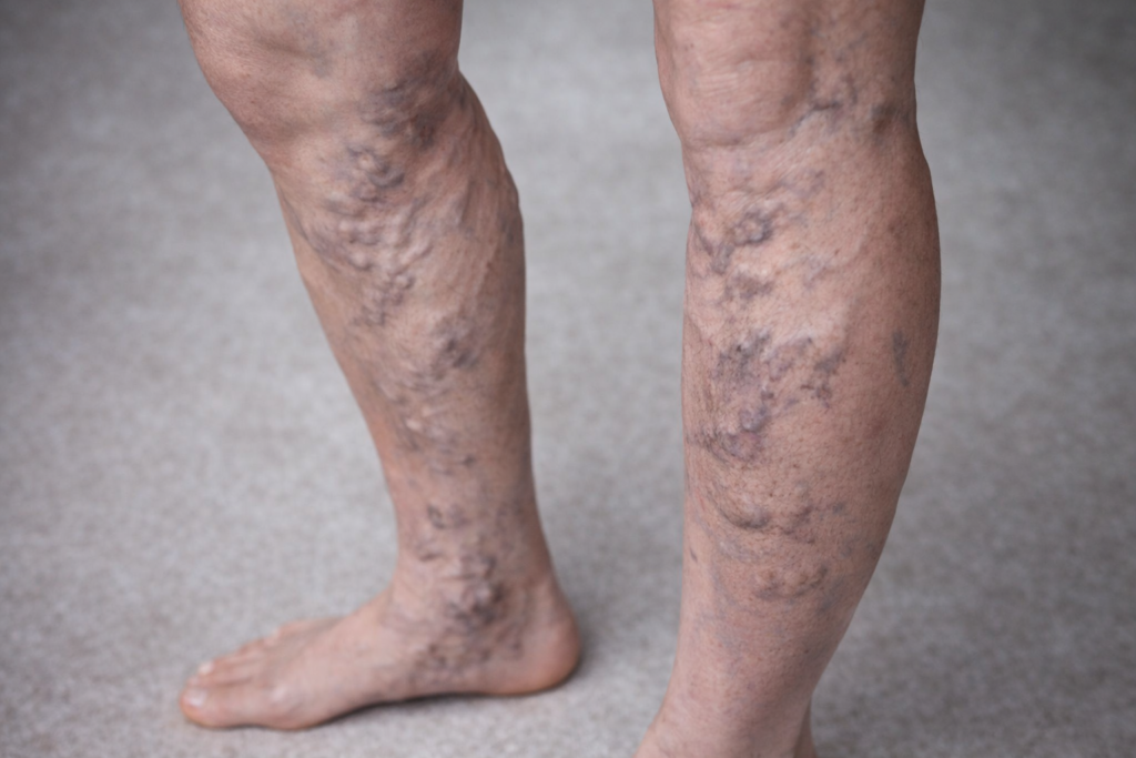 Varicose veins condition in legs showing swollen twisted veins with Ayurvedic treatment support